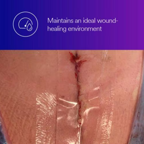 Tegaderm Absorbent Clear Acrylic Dressing