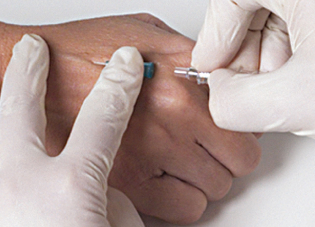 VanishPoint IV Catheter, Radiopaque PUR