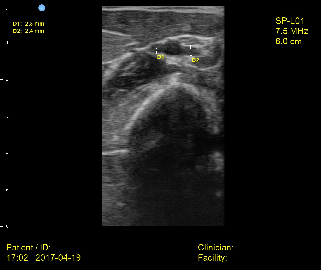 SiMPLi Point-of-Care Ultra Simple USB Ultrasound for Small Parts Imaging