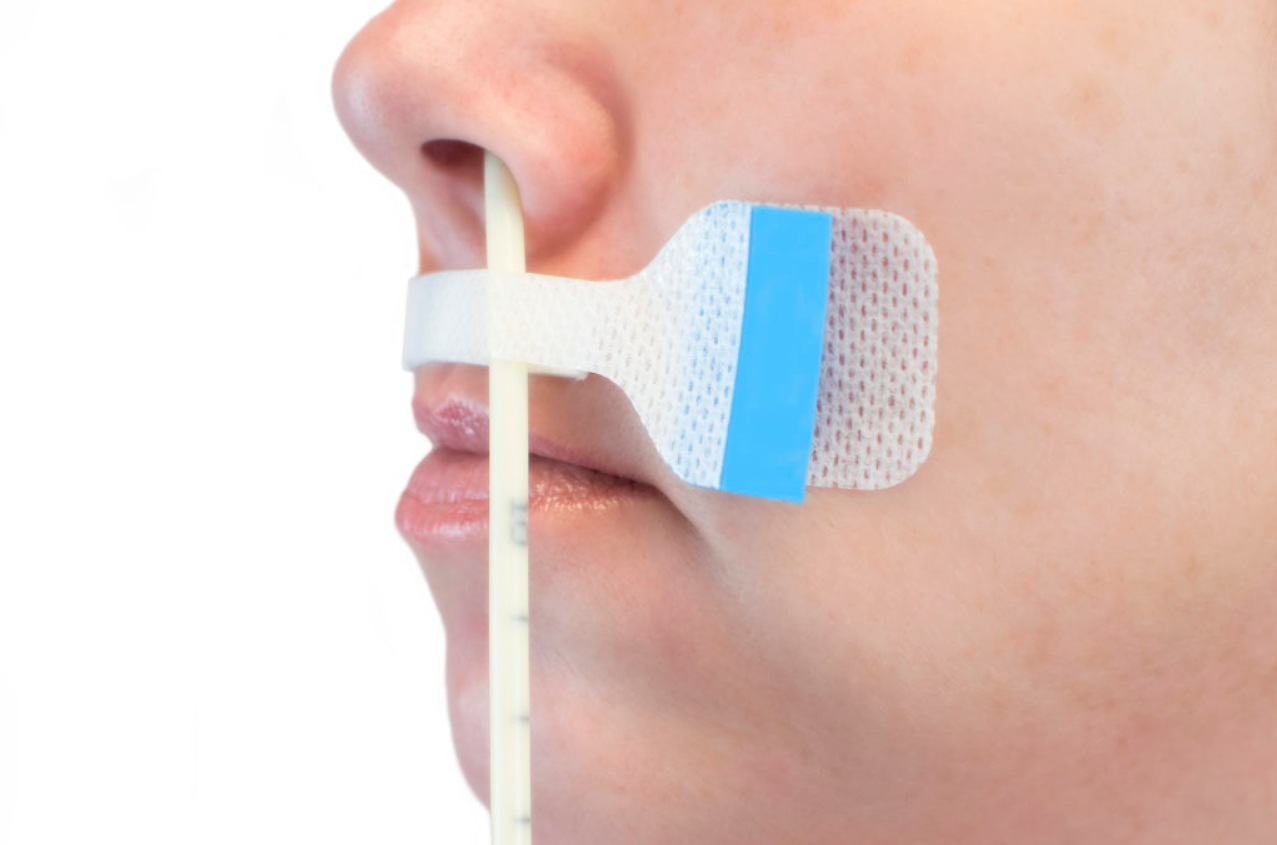 Nasogastric Securement with Foam Barrier