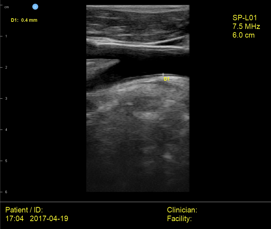SiMPLi Point-of-Care Ultra Simple USB Ultrasound for Small Parts Imaging