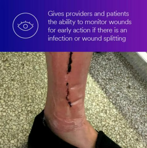 Tegaderm Absorbent Clear Acrylic Dressing