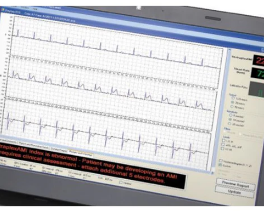 Vectraplex ECG