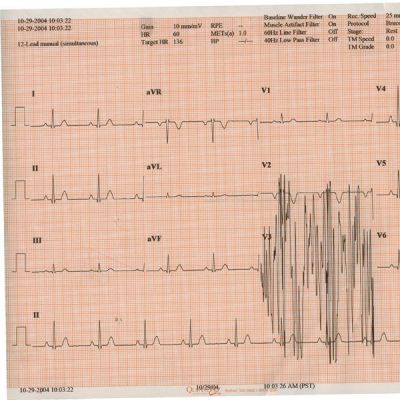 Kendall Diagnostic Recording Paperm8-1/2 Inch x 183 Foot